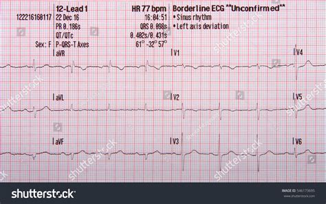 borderline ecg|borderline ecg unconfirmed.